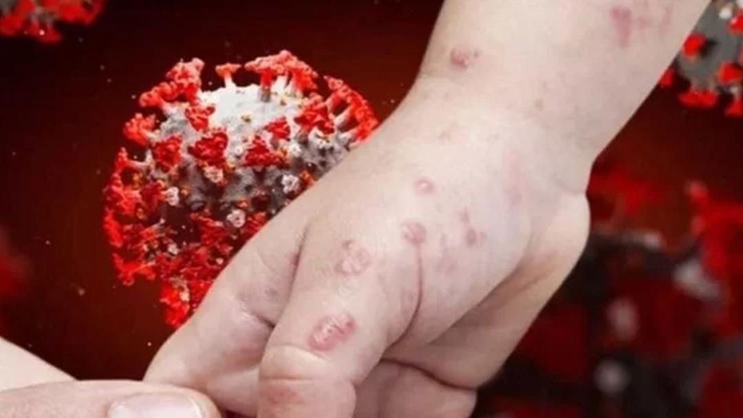 Çiçek virüsü alarmı! Hem insan hem de hayvan tarafından bulaşır, hızla yayılır: Gana da Gana 2'de 133 vakaya yükselmiştir